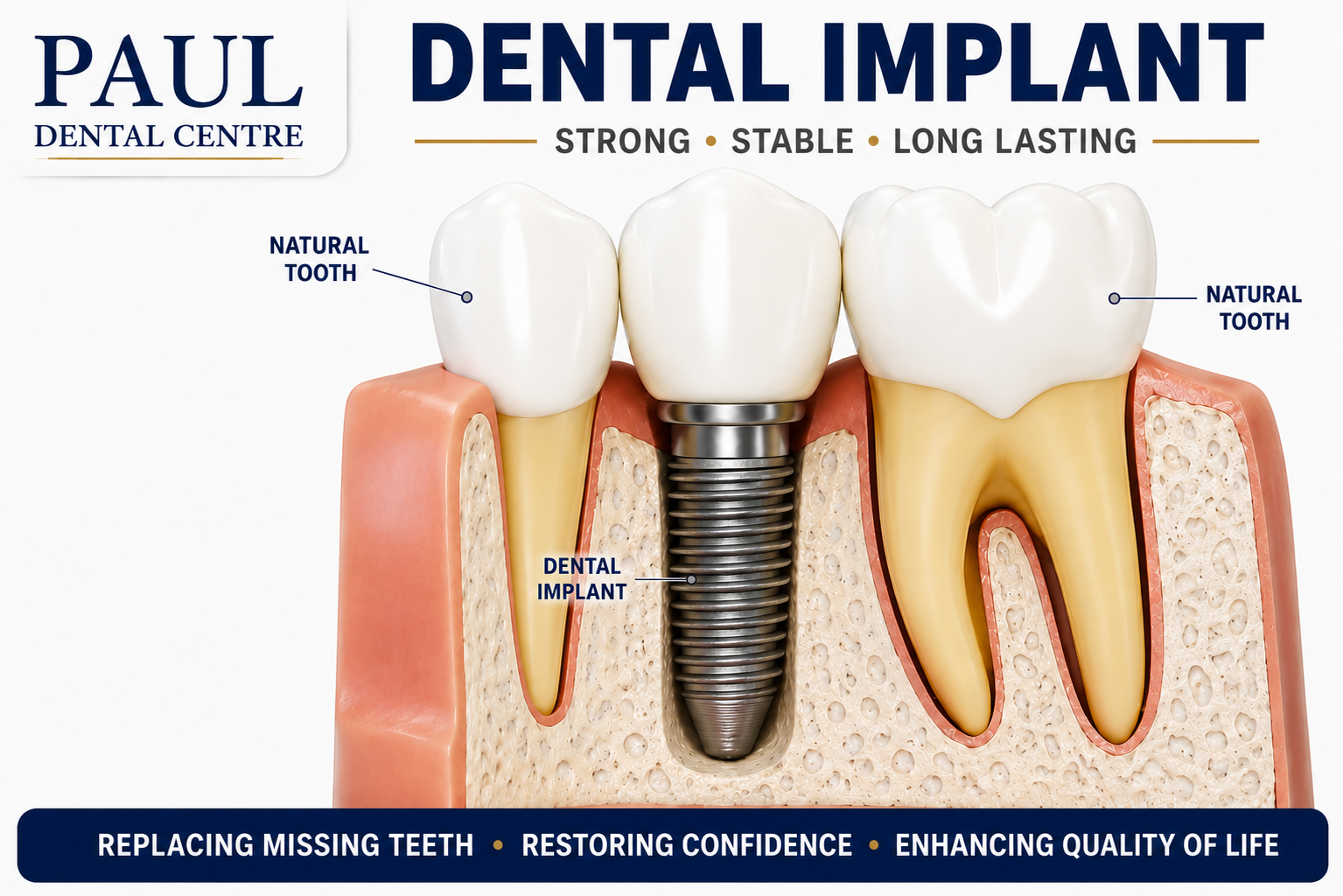 Dental Implants at Paul Dental Center